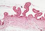 Considerations for Relapsed Myeloma Should Match Patient, Disease, and Therapy Considerations for Relapsed Myeloma Should Match Patient, Disease, and Therapy