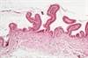 Considerations for Relapsed Myeloma Should Match Patient, Disease, and Therapy Considerations for Relapsed Myeloma Should Match Patient, Disease, and Therapy