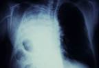 S-1 Monotherapy May Be as Effective as Platinum-Based Regimens in Non-Small Cell Lung Cancer S-1 Monotherapy May Be as Effective as Platinum-Based Regimens in Non-Small Cell Lung Cancer