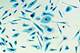 Abiraterone, Prednisone With Androgen Deprivation Therapy Show Durable Efficacy in Metastatic Castration-Naive Prostate Cancer Abiraterone, Prednisone With Androgen Deprivation Therapy Show Durable Efficacy in Metastatic Castration-Naive Prostate Cancer