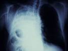 Re-treatment With Checkpoint Inhibitors in Some Patients with NSCLC May Be Feasible Re-treatment With Checkpoint Inhibitors in Some Patients with NSCLC May Be Feasible