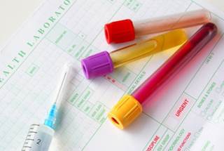 Standard flow cytometry missed the detection of the CAR19 epitope on the surface of the leukemia cells. Standard flow cytometry missed the detection of the CAR19 epitope on the surface of the leukemia cells.