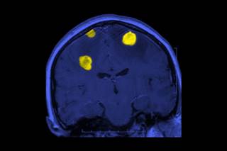 Brain metastases were HER2-positive in nearly one-third of patients with gastrointestinal primary malignancies, suggesting molecular testing may be prudent. Brain metastases were HER2-positive in nearly one-third of patients with gastrointestinal primary malignancies, suggesting molecular testing may be prudent.