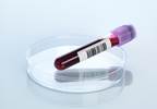 Precision Medicine: Personalizing Treatment for Multiple Myeloma Precision Medicine: Personalizing Treatment for Multiple Myeloma