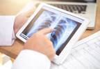 Angiotensin-Converting Enzyme Inhibitors May Increase Lung Cancer Risk Angiotensin-Converting Enzyme Inhibitors May Increase Lung Cancer Risk