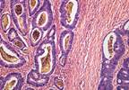 Bowel Preparation for Colorectal Cancer Screening: Improving Outcomes Bowel Preparation for Colorectal Cancer Screening: Improving Outcomes