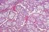 Microwave Ablation for Early-Stage Renal Tumors Microwave Ablation for Early-Stage Renal Tumors