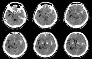Genomic and proteomic studies of medulloblastoma samples helped researchers characterize new cancer subtypes and targets. Genomic and proteomic studies of medulloblastoma samples helped researchers characterize new cancer subtypes and targets.