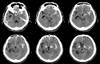 Proteomics Study Reveals New Medulloblastoma Subtypes and Potential Novel Treatment Targets Proteomics Study Reveals New Medulloblastoma Subtypes and Potential Novel Treatment Targets