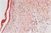 Encorafenib Plus Binimetinib Offers a New Option for MEK+BRAF Inhibition Encorafenib Plus Binimetinib Offers a New Option for MEK+BRAF Inhibition