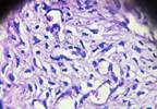 Effect of BRCA Mutations on Ovarian Reserve After Chemotherapy Effect of BRCA Mutations on Ovarian Reserve After Chemotherapy