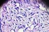 Effect of <I>BRCA</i> Mutations on Ovarian Reserve After Chemotherapy Effect of <I>BRCA</i> Mutations on Ovarian Reserve After Chemotherapy