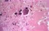 Lenalidomide Maintenance Therapy for Multiple Myeloma Lenalidomide Maintenance Therapy for Multiple Myeloma