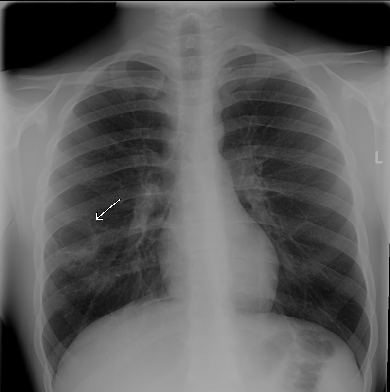 Plain Radiograph Of Child With A Cavitary Fungal Nodule Plain Radiograph Of Child With A Cavitary Fungal Nodule