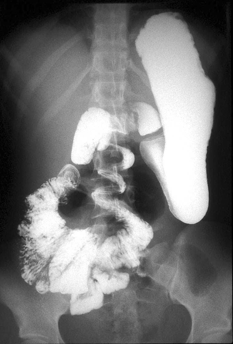 Intestinal Malrotation And Midgut Volvulus Image