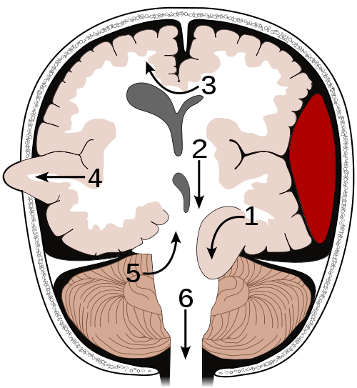 Increased Intracranial Pressure - Cancer Therapy Advisor