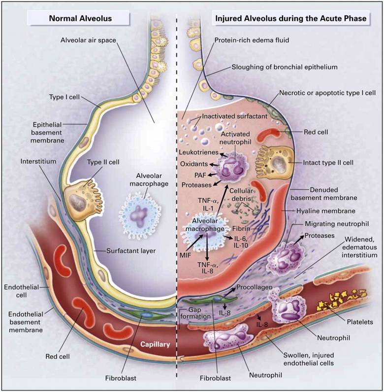 pulmonary edema lung sounds