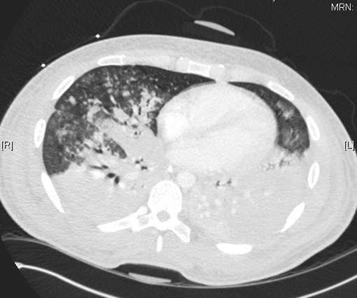 Acute Respiratory Distress Syndrome; Acute Hypoxemic Respiratory