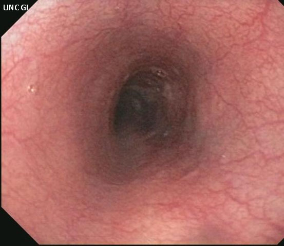 esophageal esophagus normal endoscopic strictures stricture cancer appearance