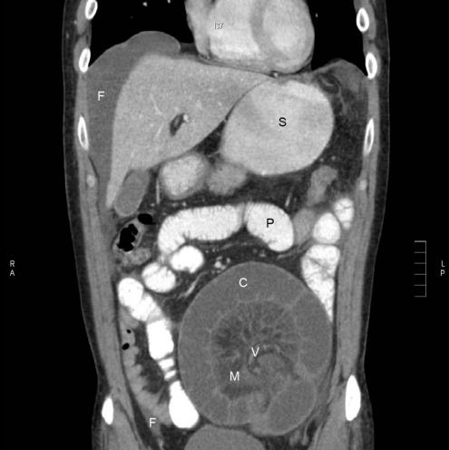 Approach to the patient with intestinal obstruction - Cancer Therapy ...