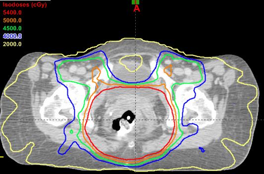 Anal Cancer - Cancer Therapy Advisor