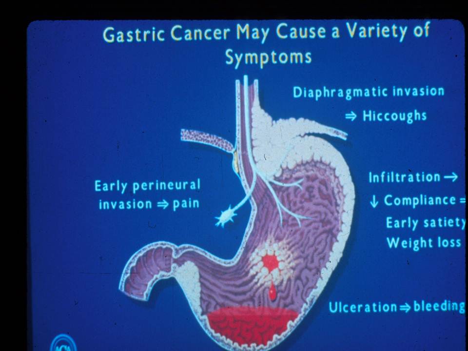 gastric cancer patient journey