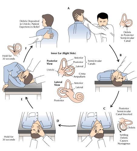 Meclizine for bppv nystagmus