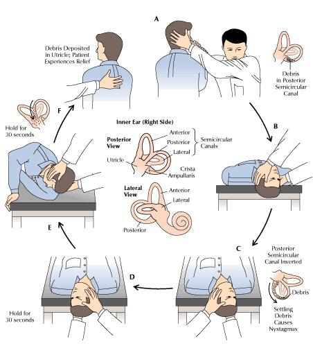 benign paroxysmal positional vertigo epley maneuver benign paroxysmal positional vertigo epley maneuver