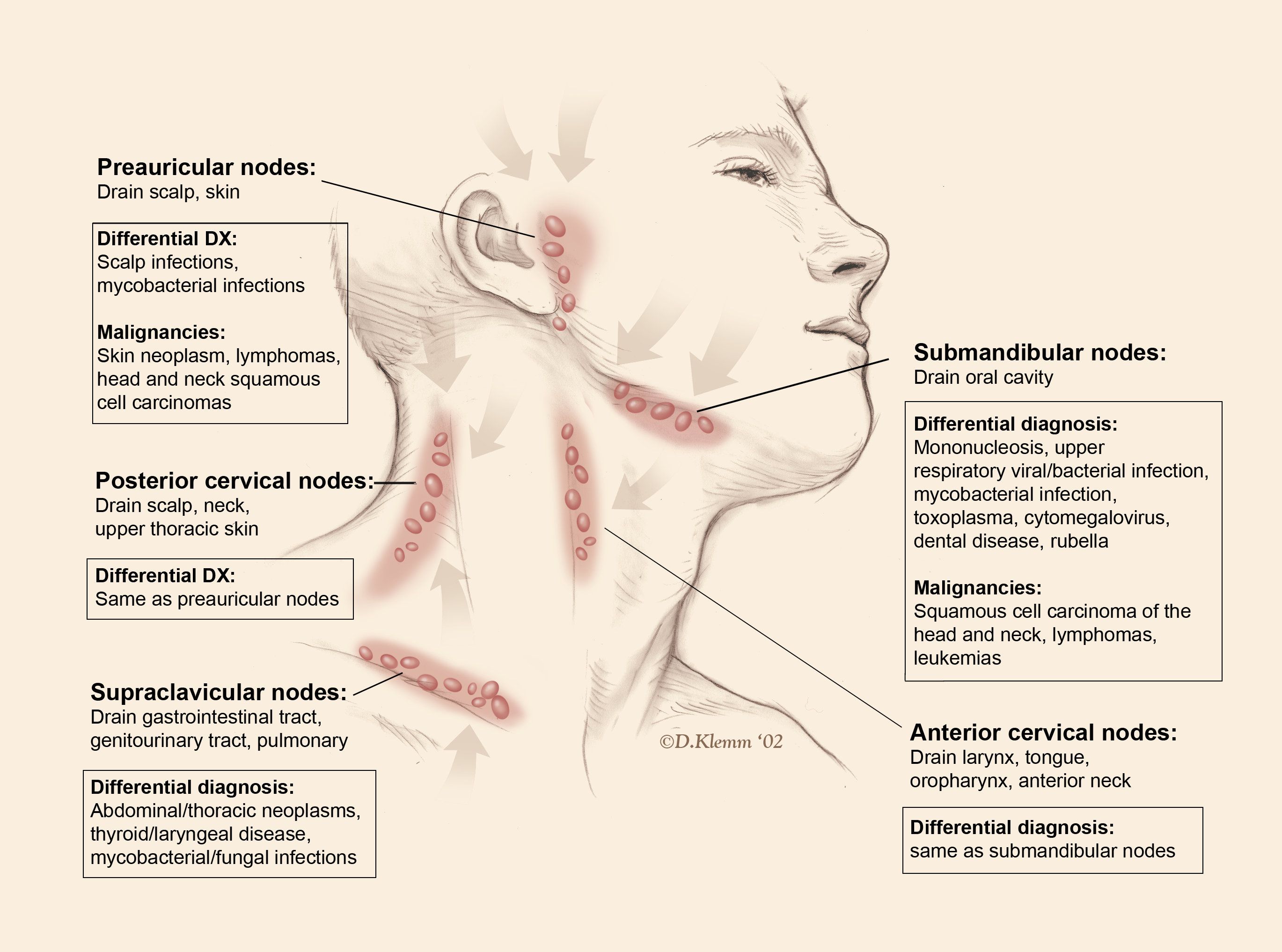 lymph node back of neck hard