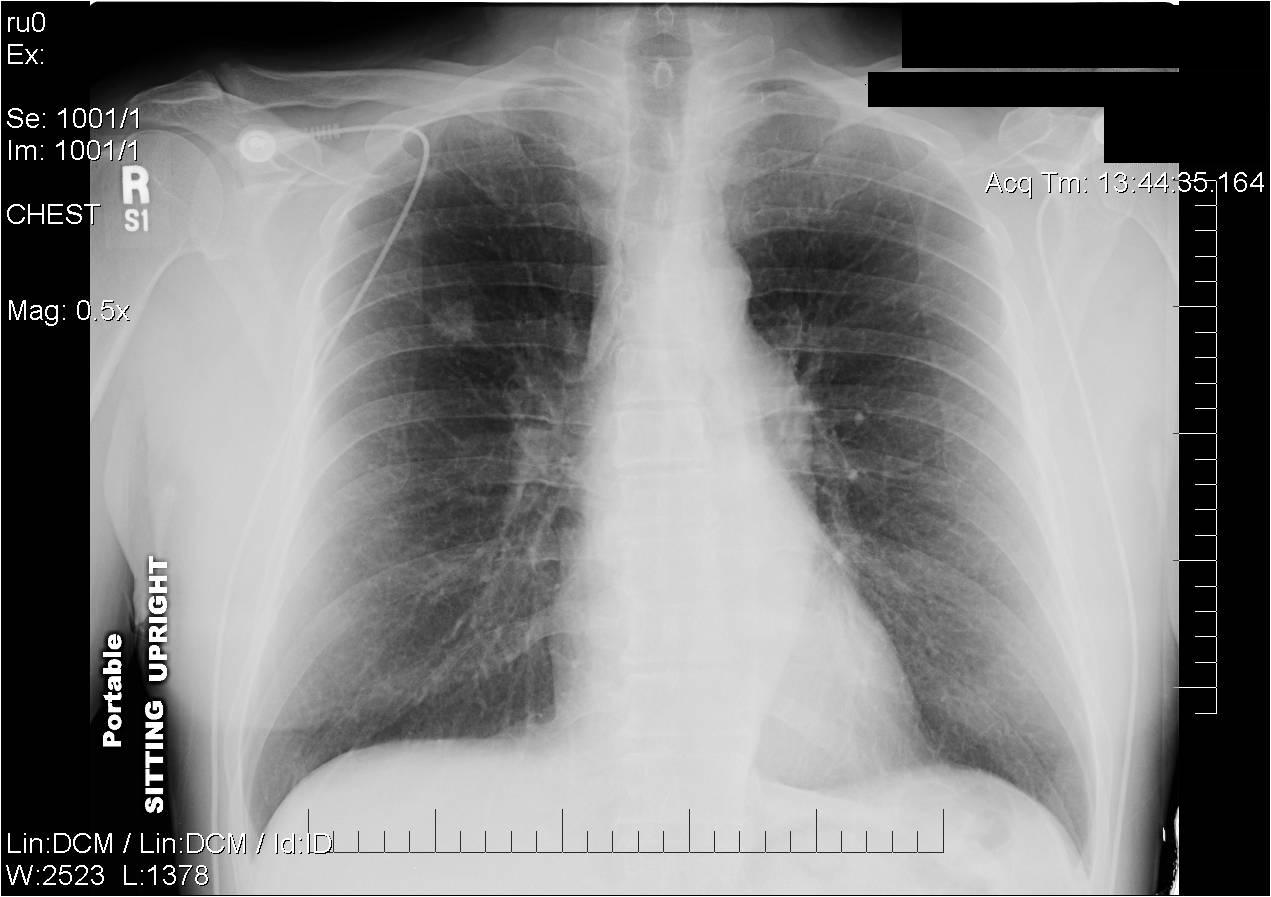 Diflucan for yeast x ray