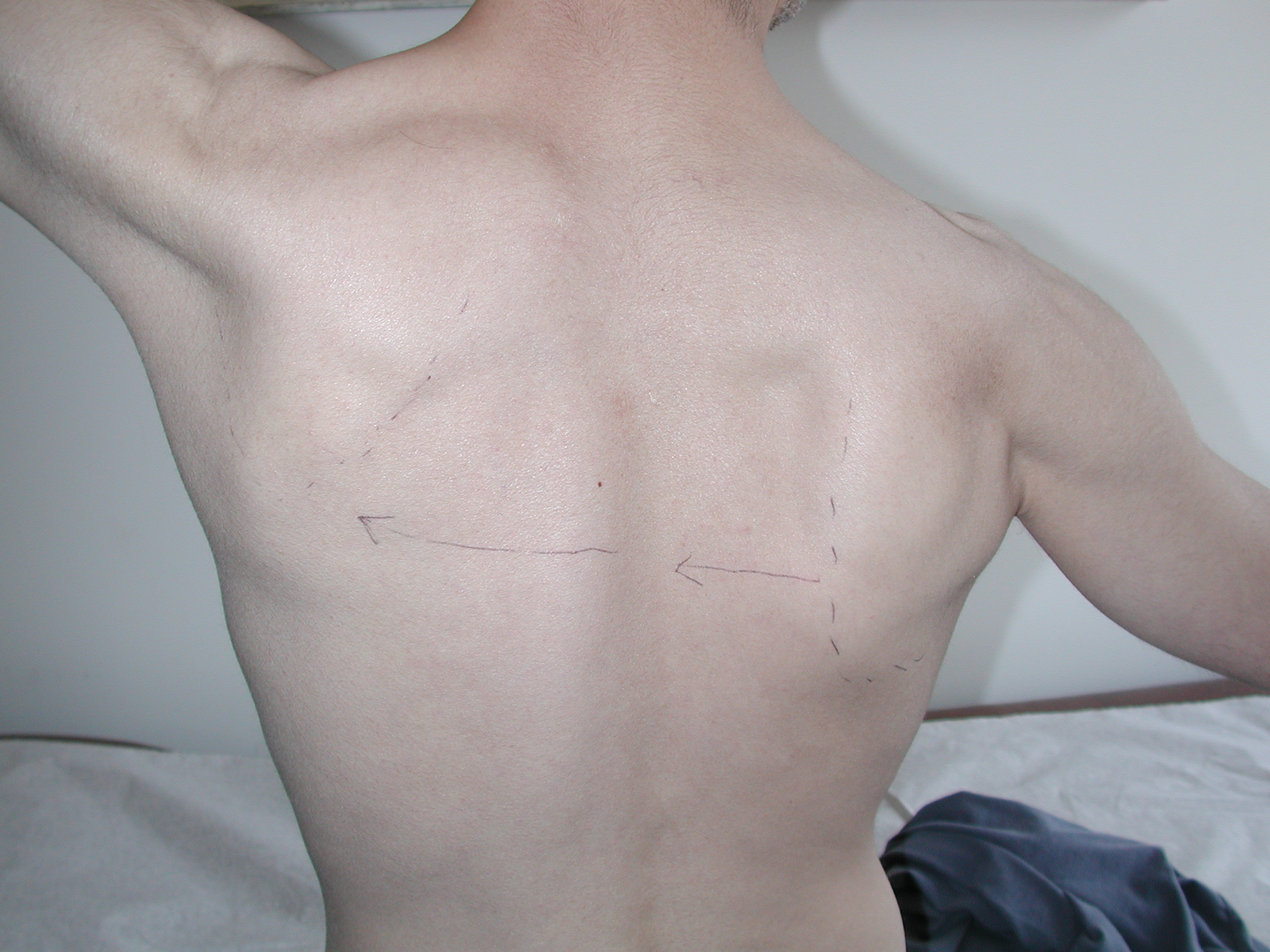 Evaluation and Management of Scapular Winging due to spinal accessory