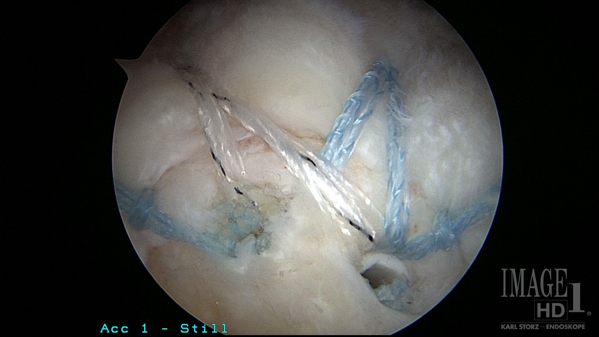 Managing The Failed Rotator Cuff Repair Cancer Therapy Advisor